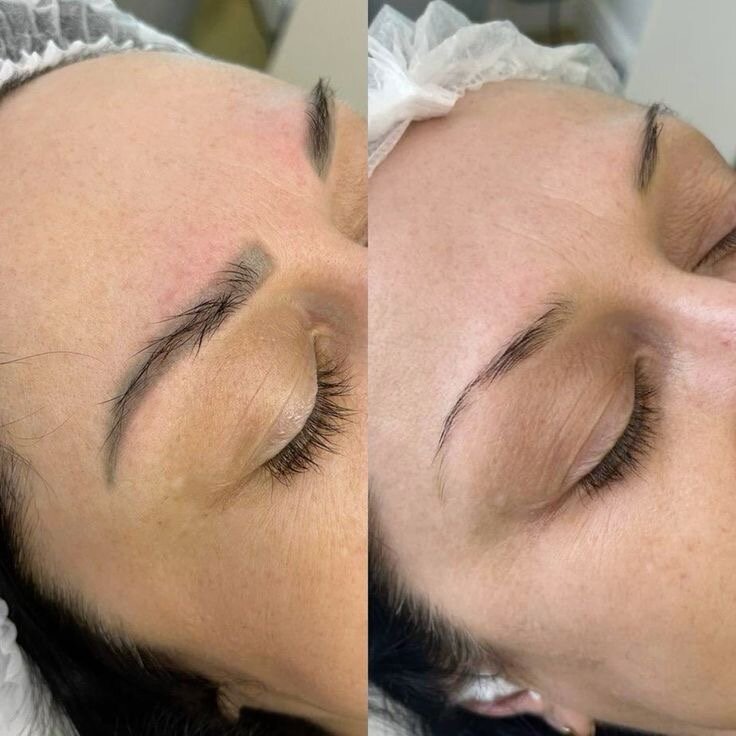 Удаление татуажа