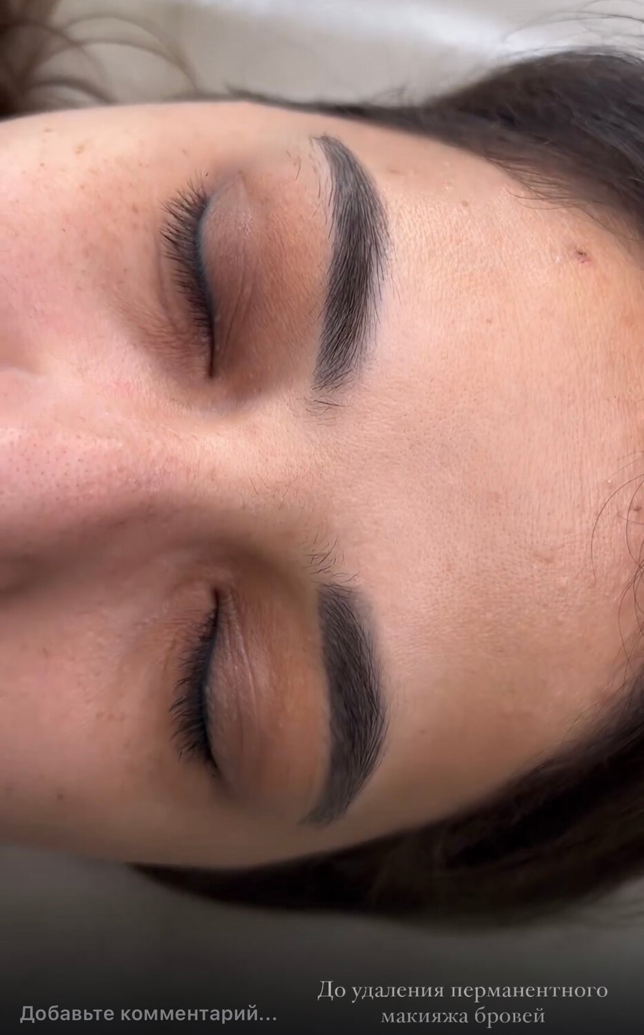Лазерное удаление татуажа перманентного макияжа бровей