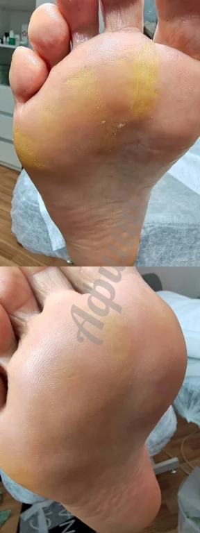 Уход за кожей стоп