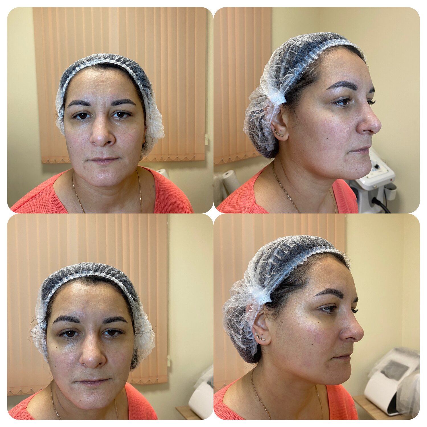 Смас-лифтинг