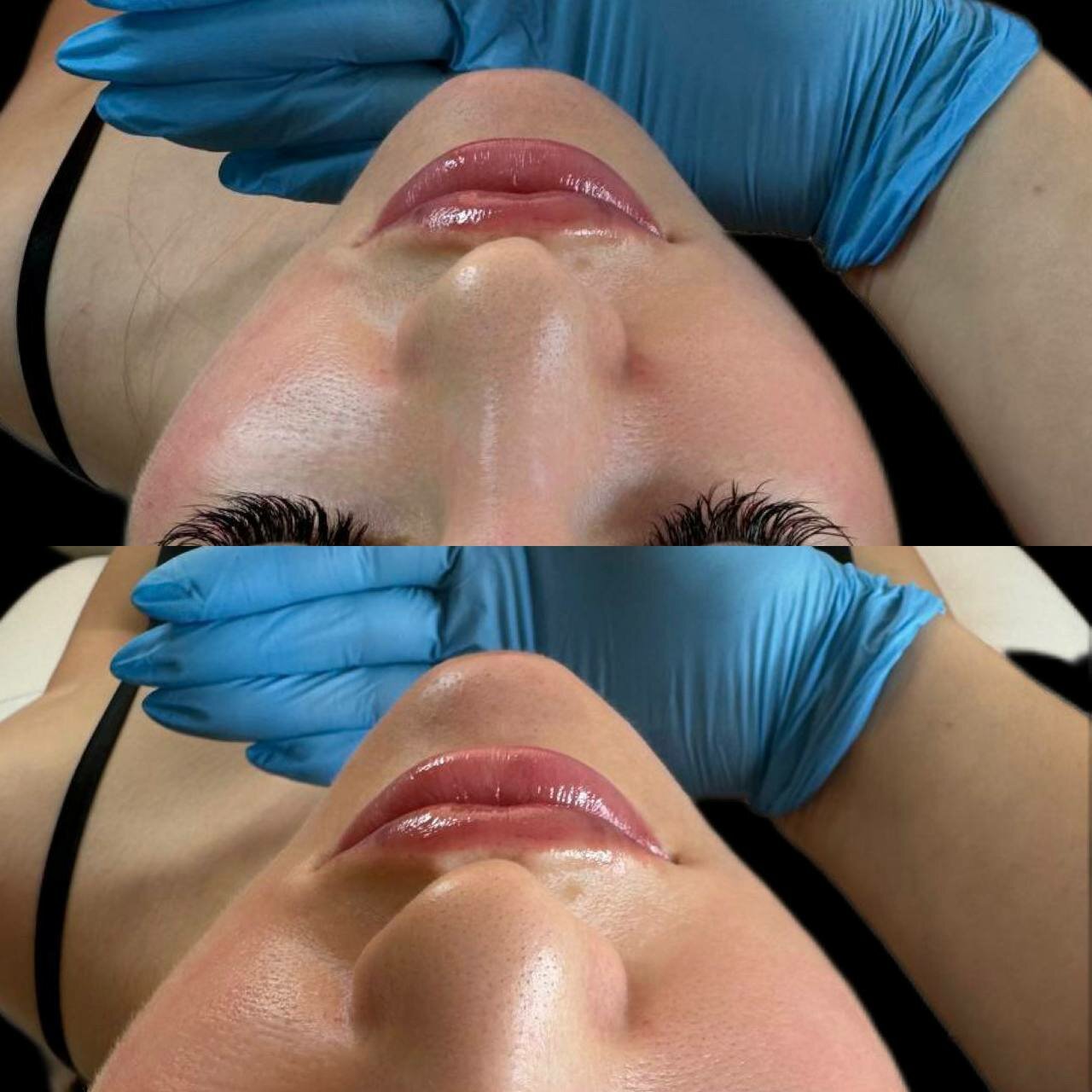 Филлеры с гиалуроновой кислотой