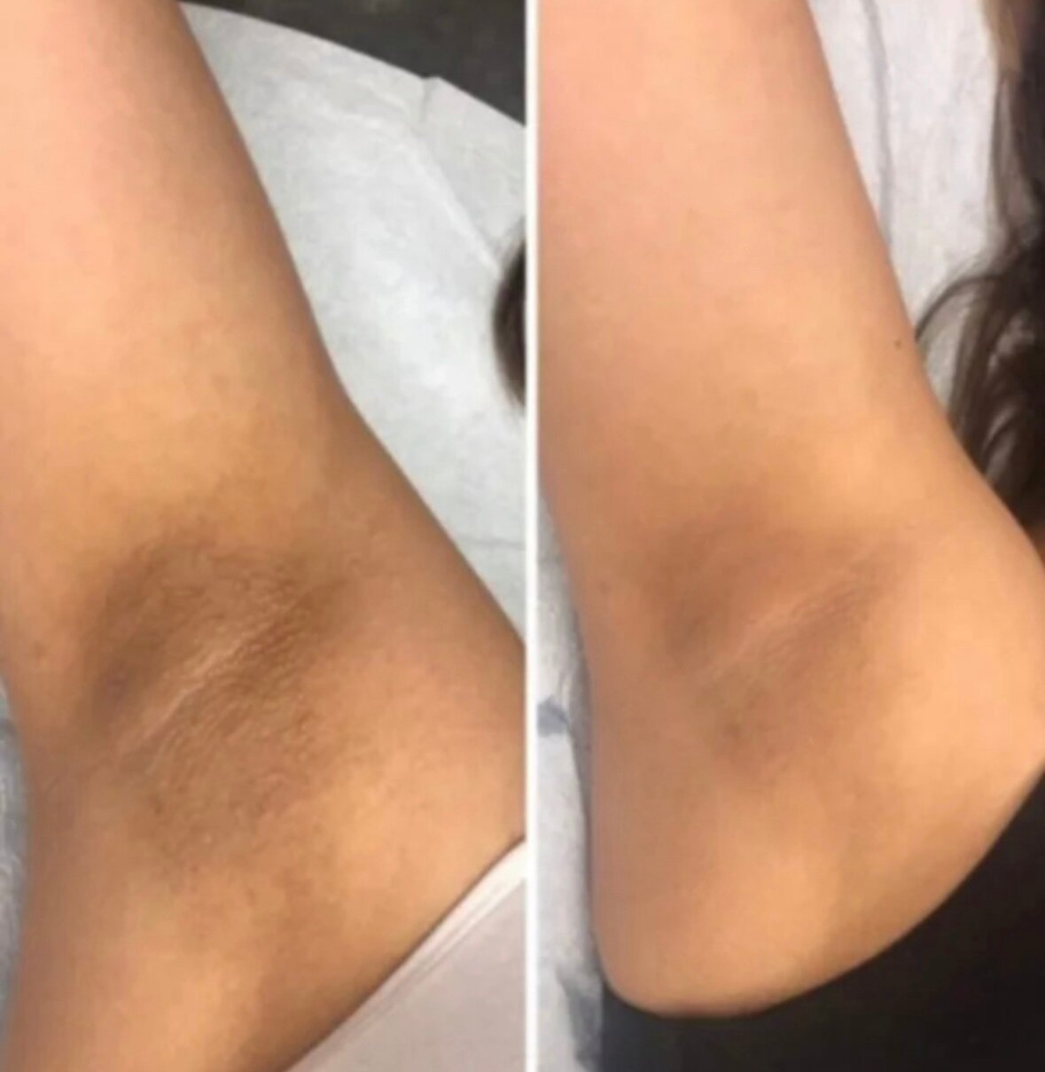 Интимный осветляющий пилинг