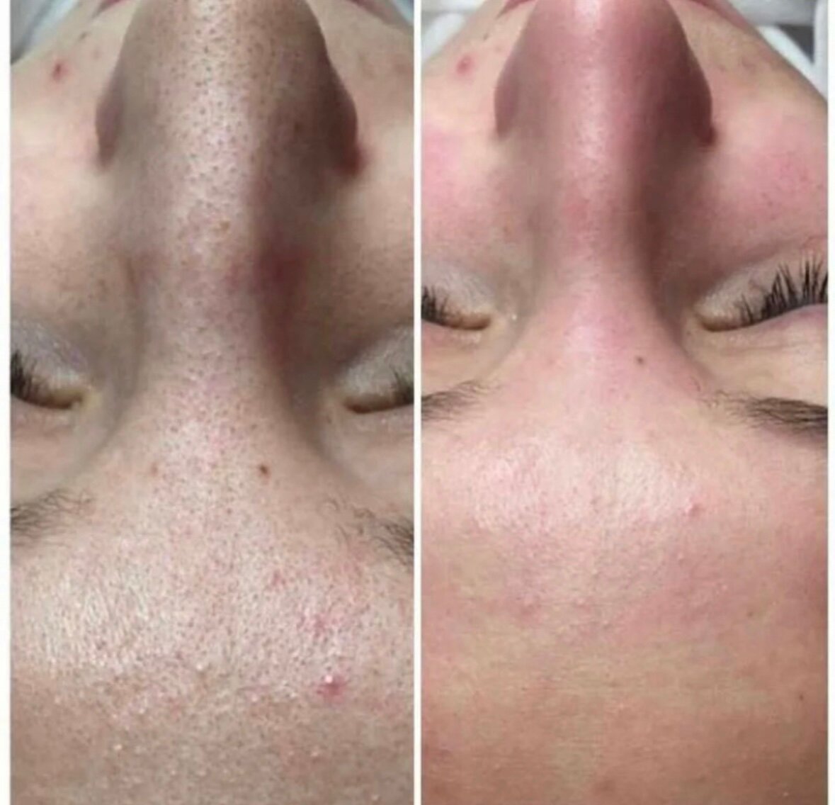 Ультразвуковая чистка лица