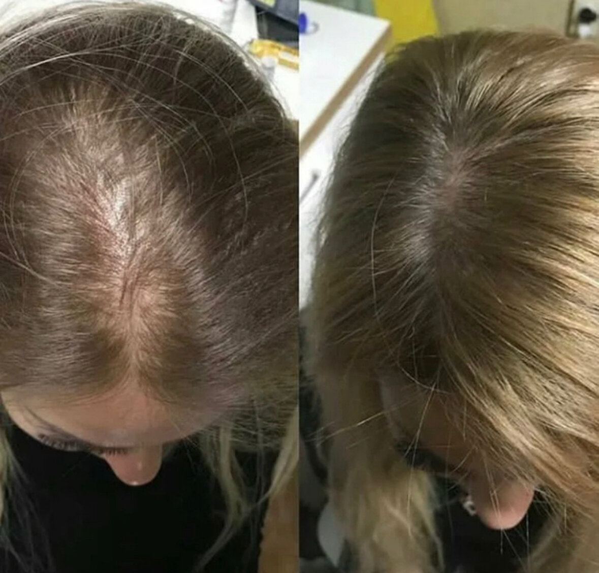 Мезотерапия волосистой части головы(разовая процедура)