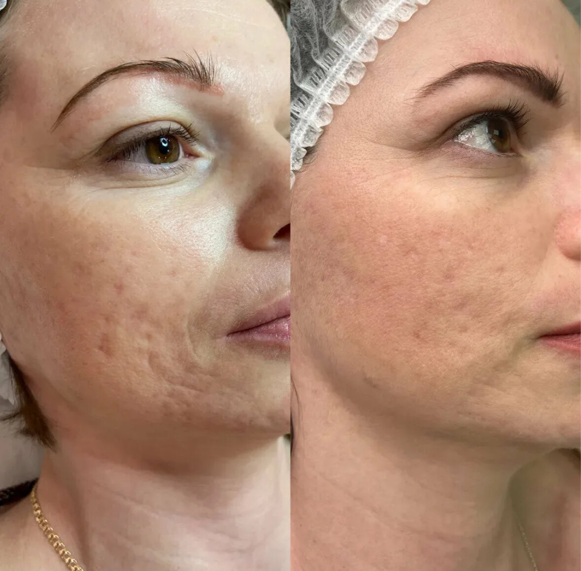 Микроигольчатый РФ лифтинг