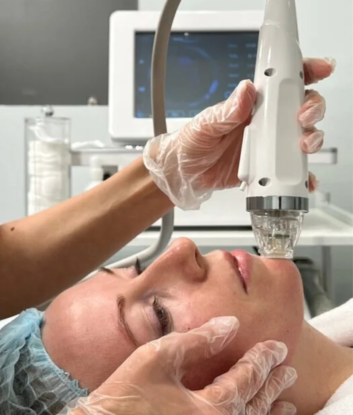 Микроигольчатый РФ лифтинг