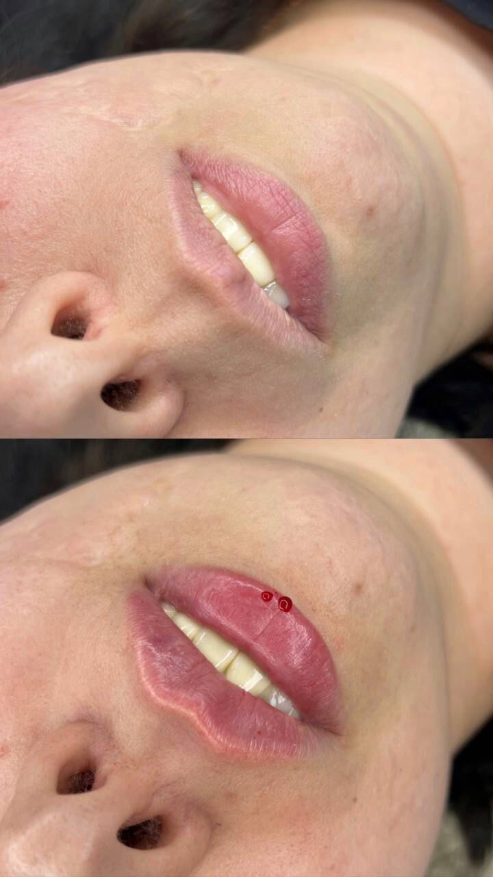 Увеличение губ