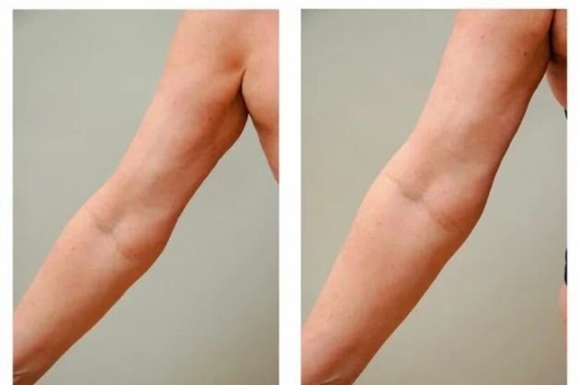 Смас-лифтинг