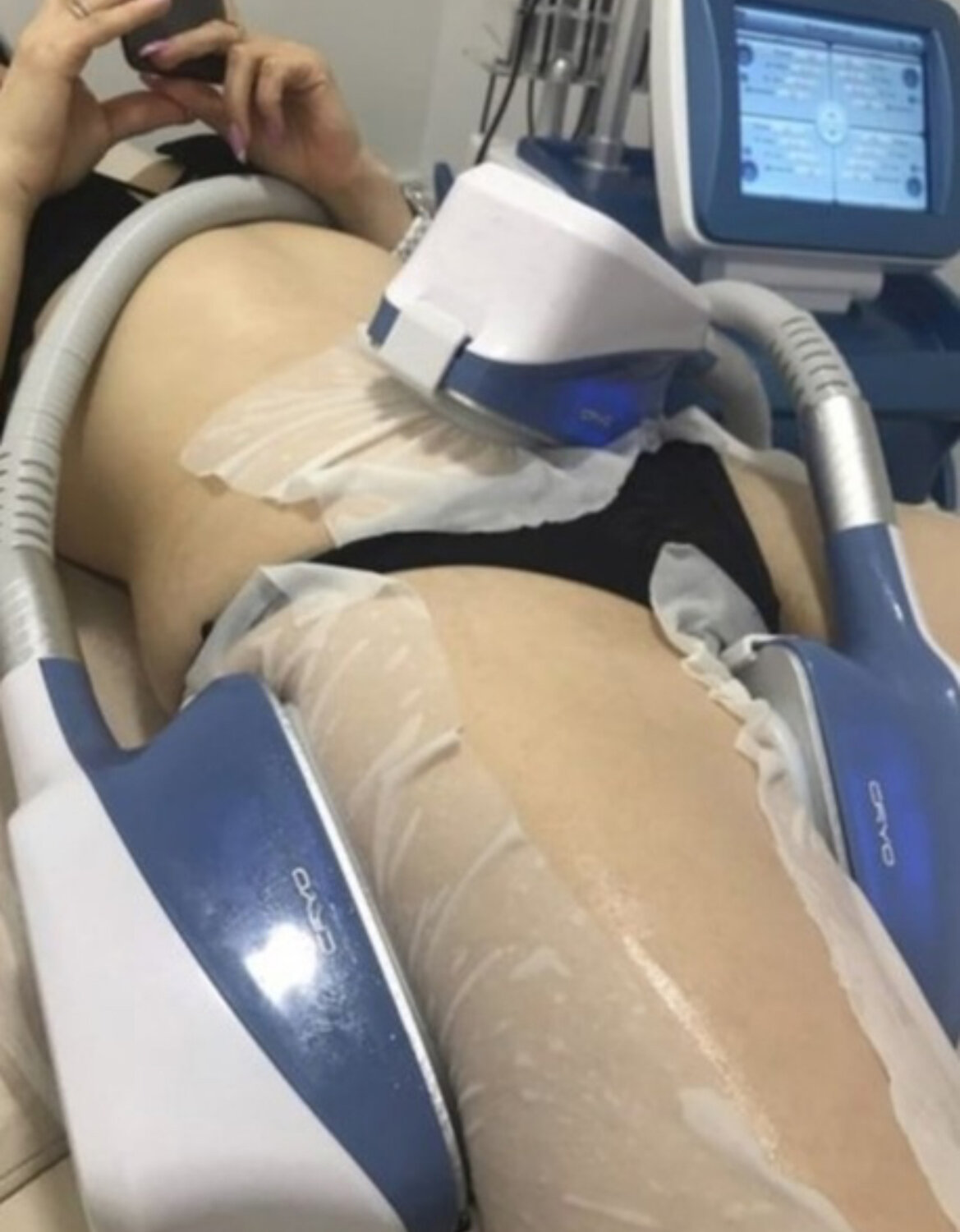 Криолиполиз