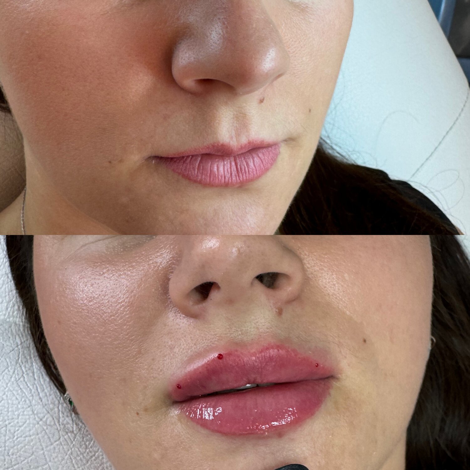 Увеличение губ