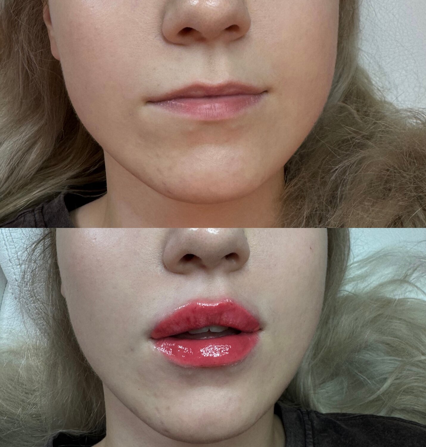 Увеличение губ