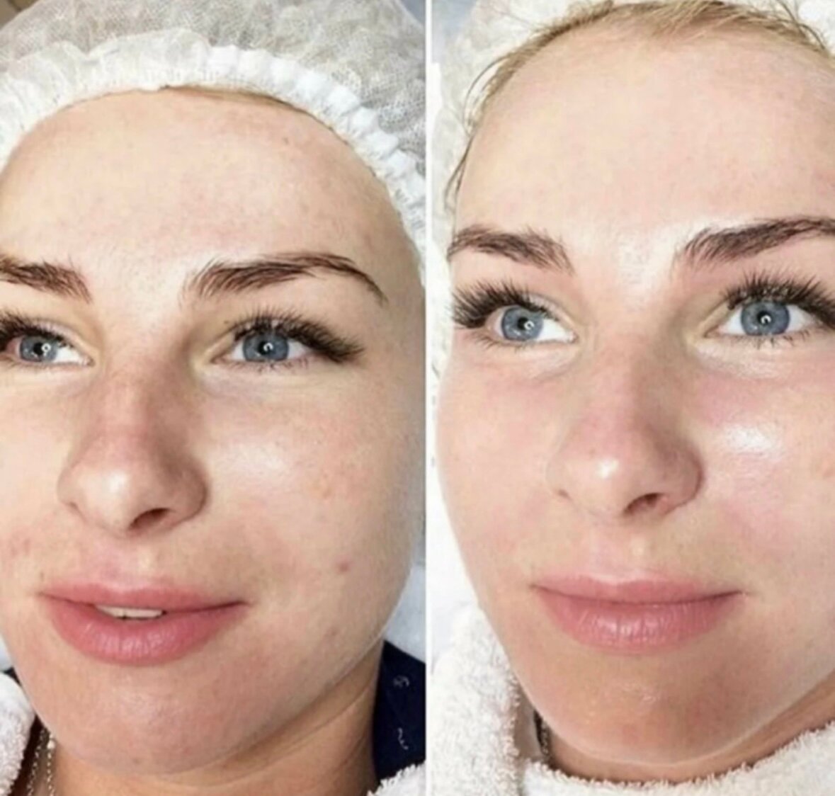 Химический пилинг лица