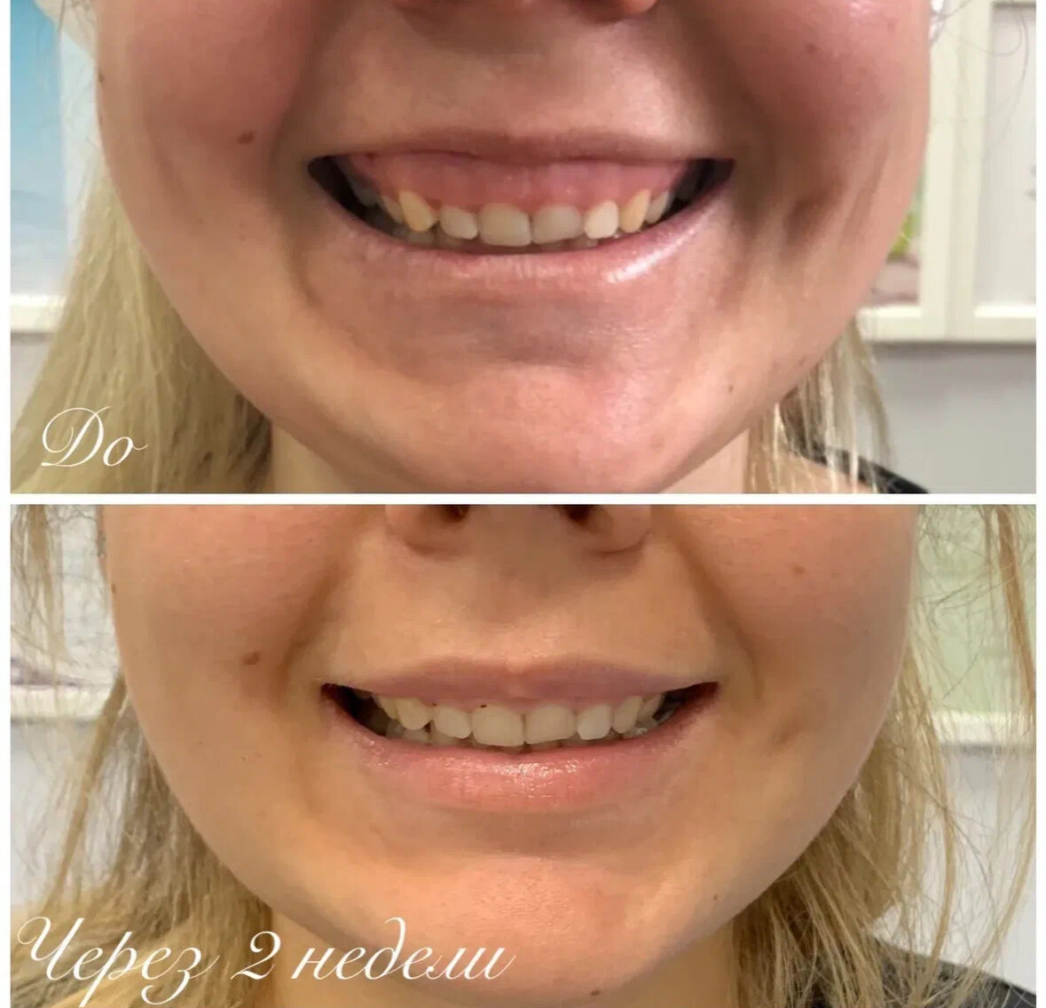 Ботокс в губы