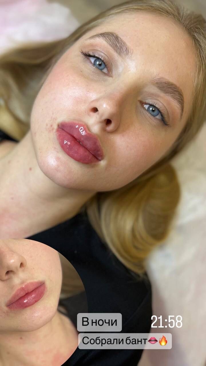 Увеличение губ