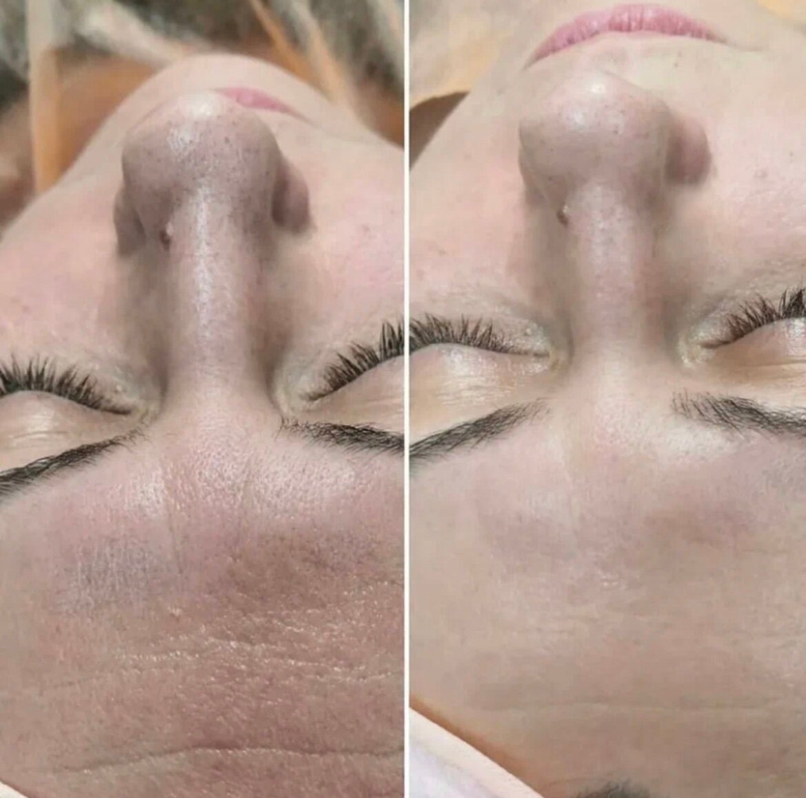 Ультразвуковая чистка лица