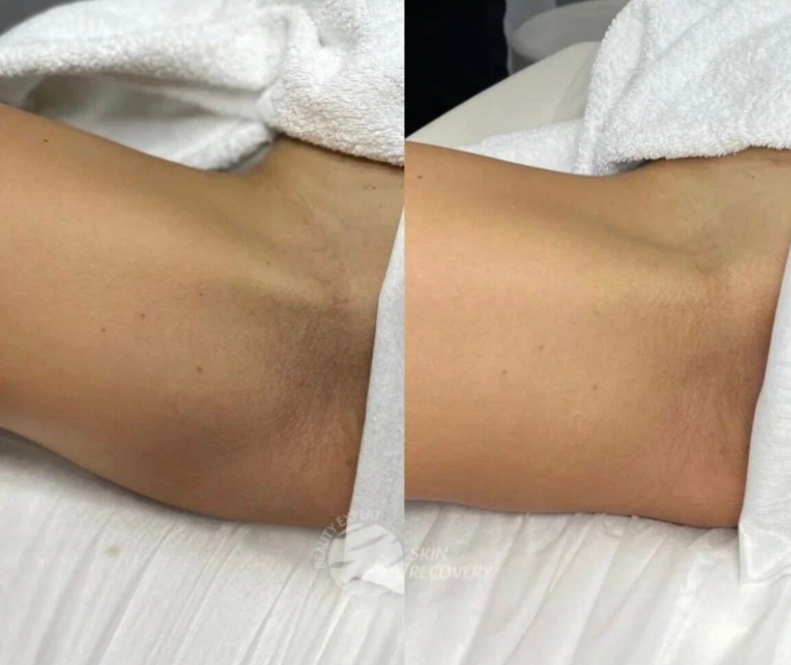 Интимный осветляющий пилинг